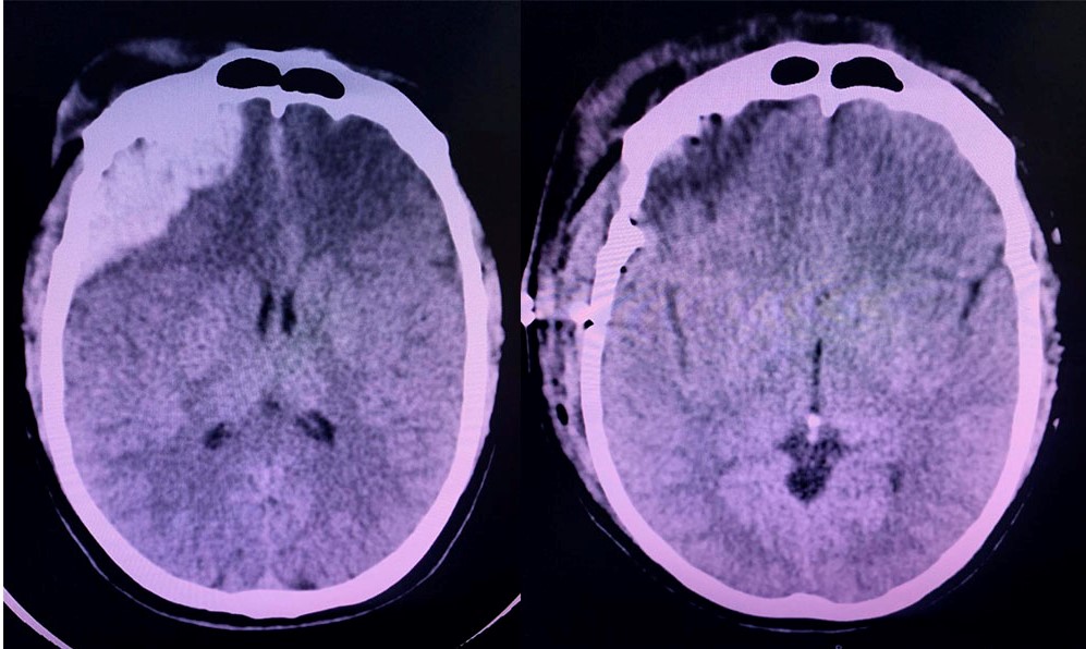 Hematoma epidural