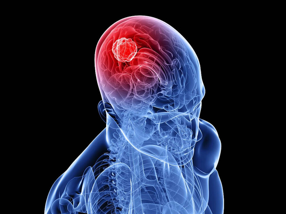 Tumor cerebral