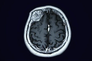 craneotomía para la extirpación de un tumor cerebral