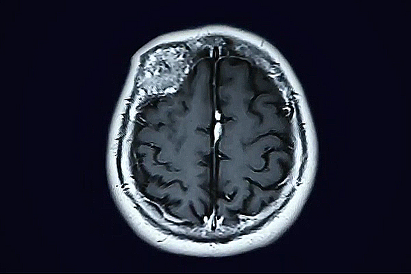 craneotomía para la extirpación de un tumor cerebral