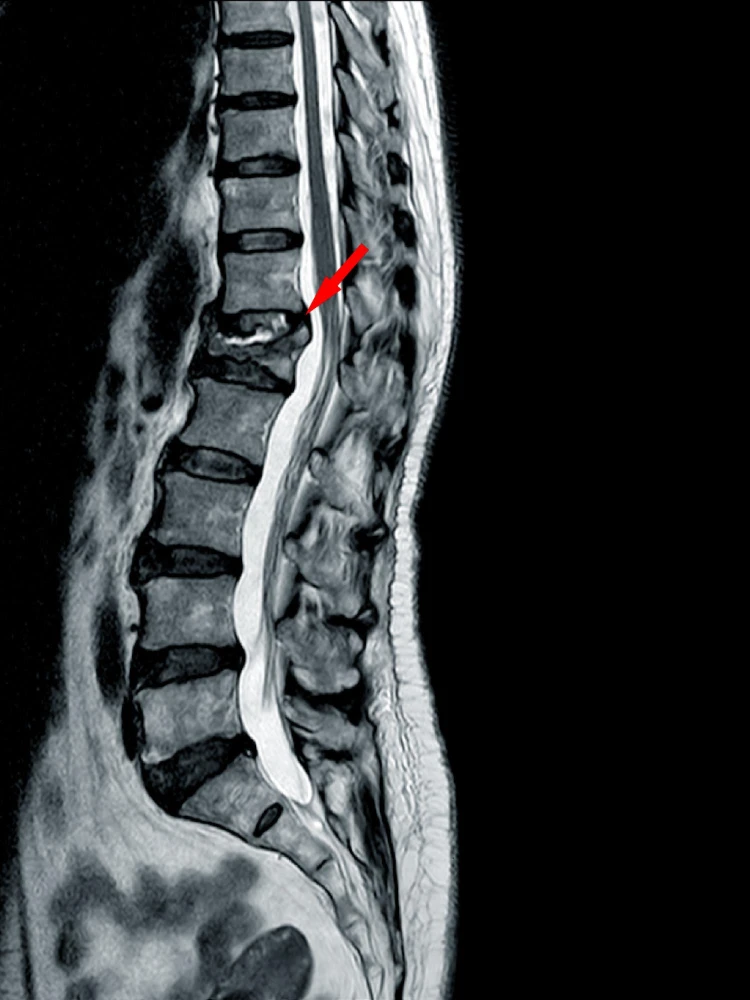Fractura Vertebral